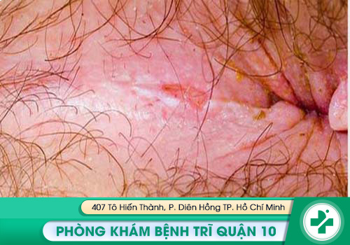Hình ảnh về nứt kẽ hậu môn