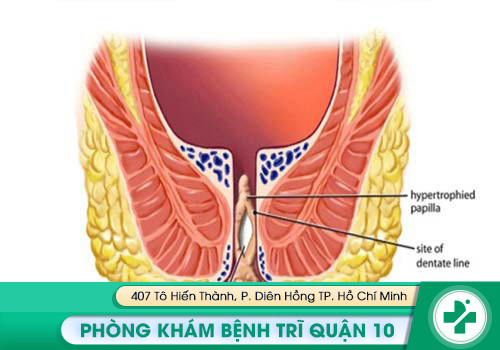 Sa hậu môn nếu không được điều trị sớm sẽ gây nhiều biến chứng nguy hiểm