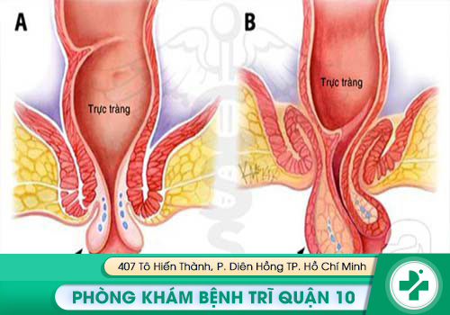Sa hậu môn trực tràng do nhiều nguyên nhân gây ra và có dấu hiệu tương tự bệnh trĩ