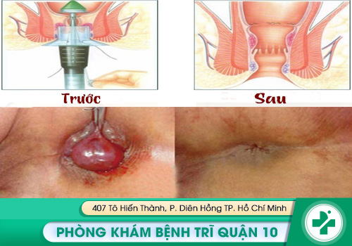 Cắt trĩ bằng phương pháp PPH đảm bảo an toàn, thẩm mỹ, không biến chứng