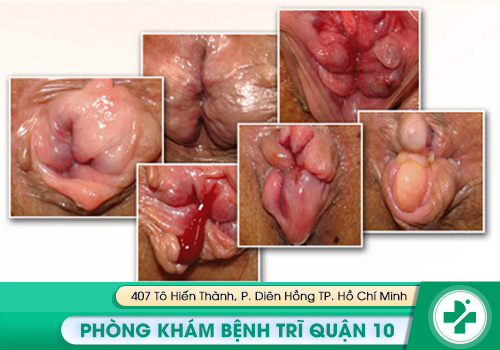 Hình ảnh về bệnh trĩ