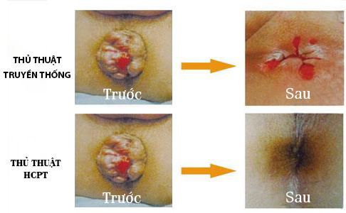 Trước và sau khi điều trị bằng HCPT